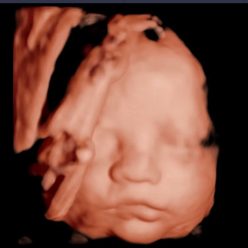 Ultrasonido 3D del rostro fetal