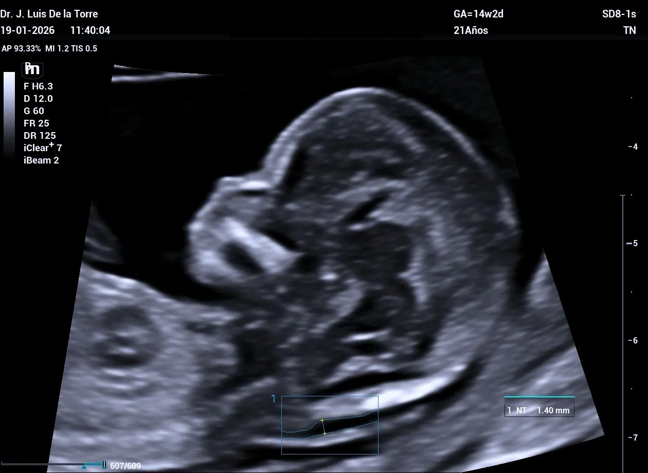 Ultrasonido Obstétrico de Tamizaje (11-14 semanas)