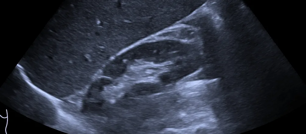 Ultrasonido abdominal