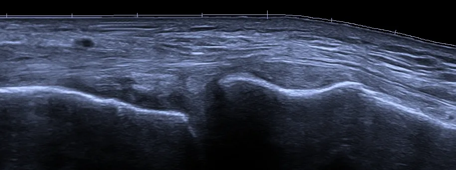 Ultrasonido articular