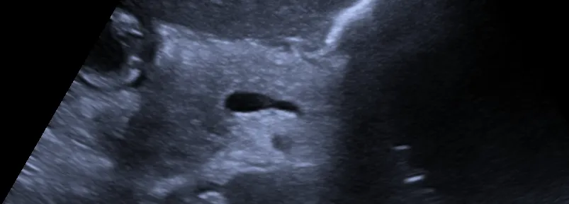 Ultrasonido de abdomen superior