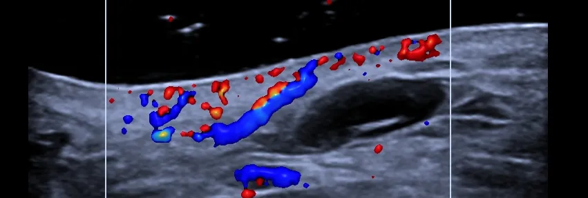 Ultrasonido dermatológico
