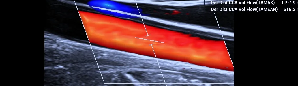 Ultrasonido Doppler de carótidas