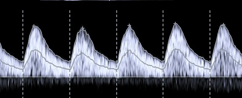 Ultrasonido Doppler obstétrico