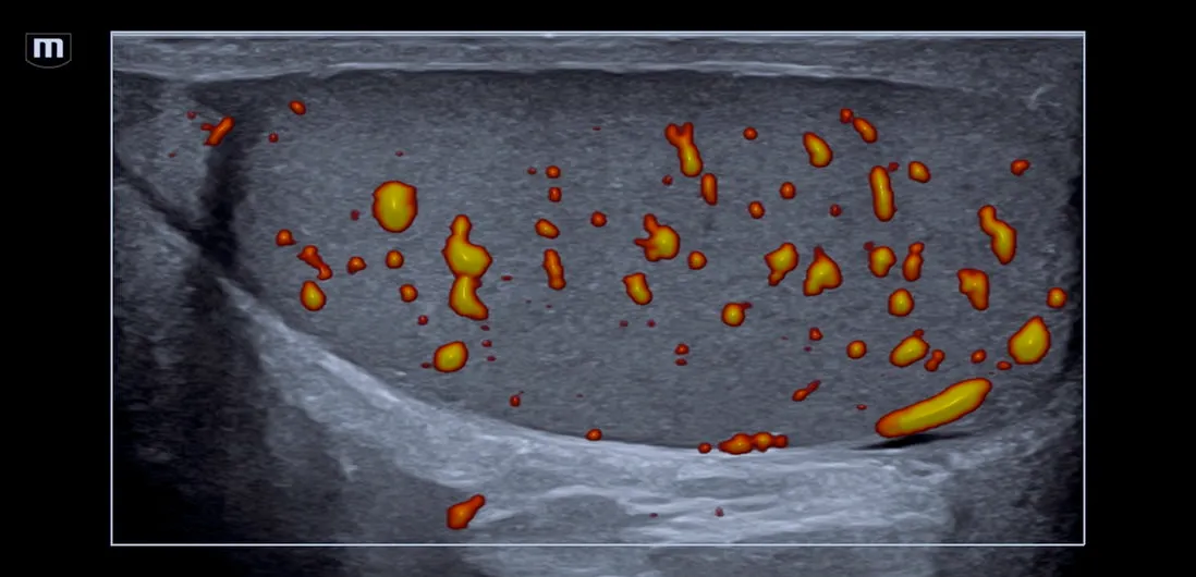 Ultrasonido Doppler testicular