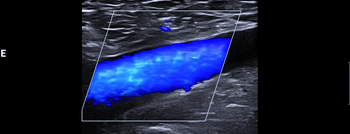 Ultrasonido Doppler venoso de miembro inferior (pierna)
