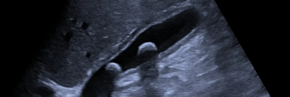 Ultrasonido hepatovesicular