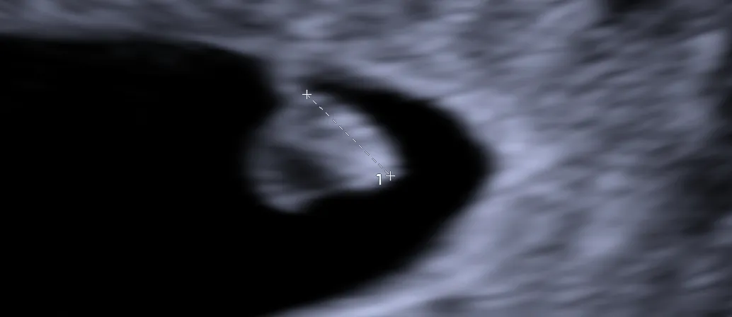 Ultrasonido Obstétrico Temprano (diagnóstico de embarazo <11 semanas)