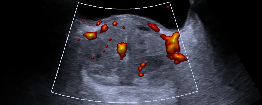 Ultrasonido prostático (vía abdominal)