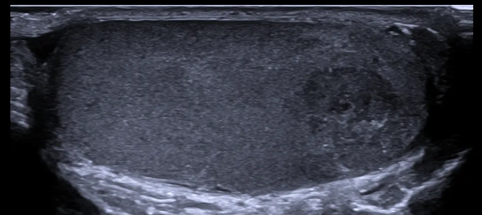 Ultrasonido testicular
