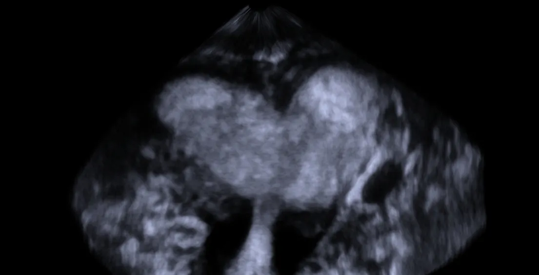 Ultrasonido transvaginal