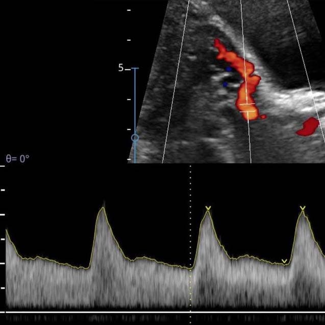 Ultrasonido Doppler